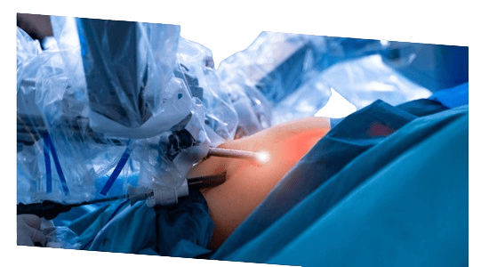 Cirugía para cáncer gástrico en Torreón