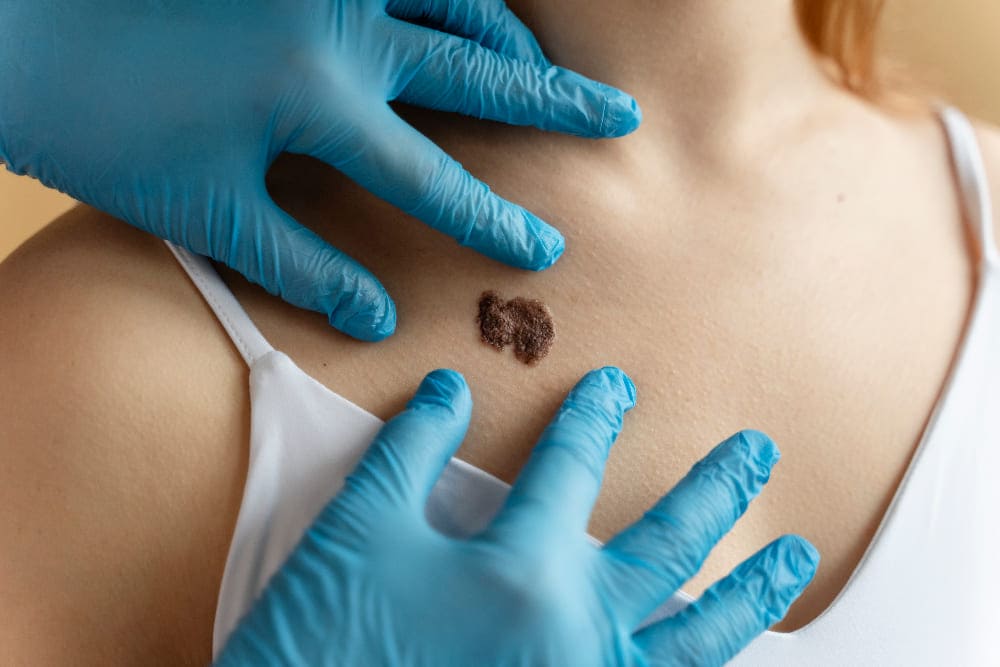 Procedimientos Oncológicos por Laparoscopia en Torreón