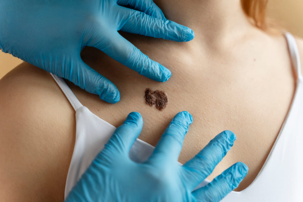 Cirugía de melanoma: Tratamiento integral para tumores de piel